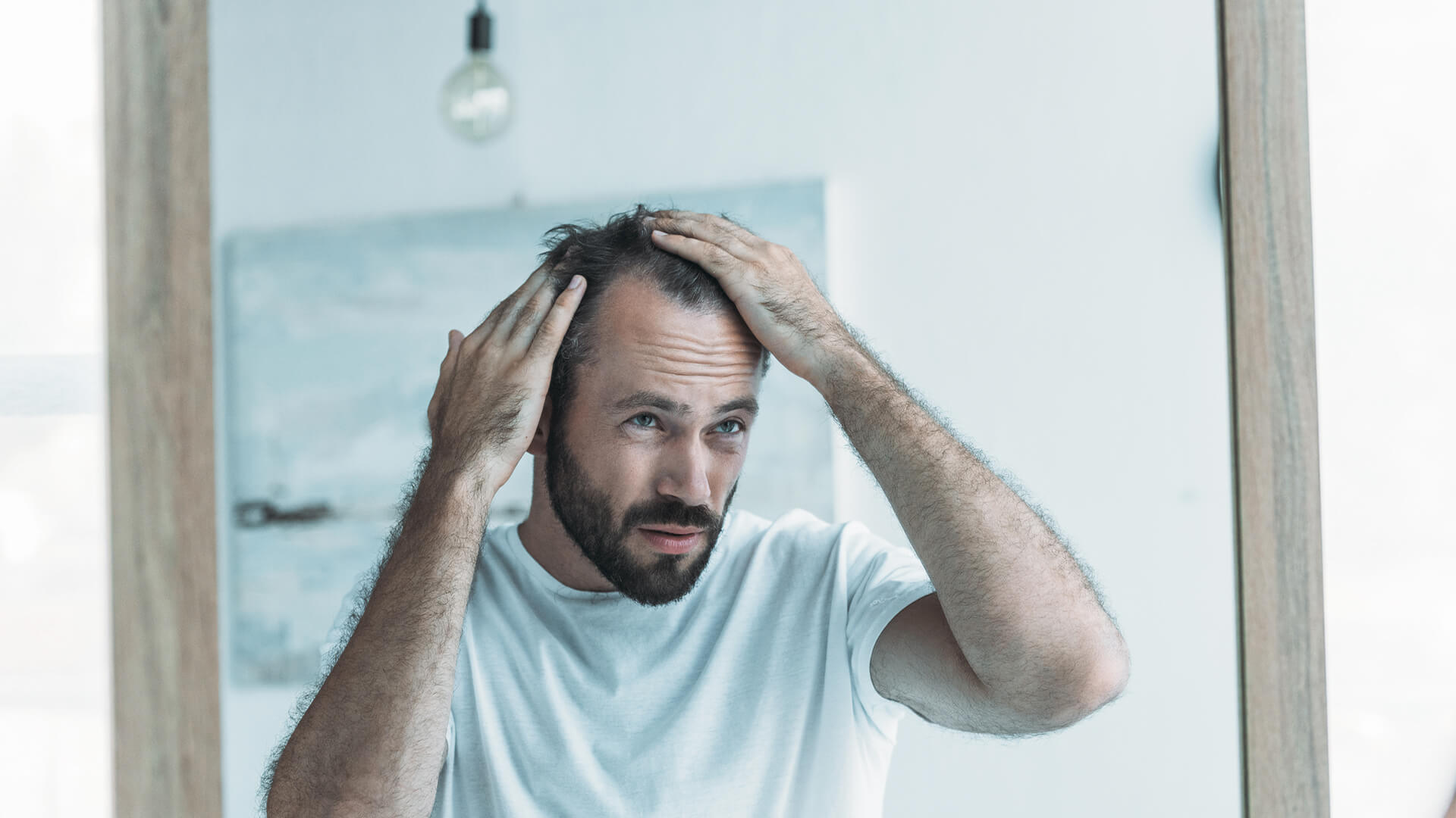 Male Hair Loss